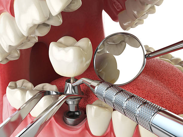Best Emergency Dental Care for Broken or Chipped Teeth in Lino Lakes, MN